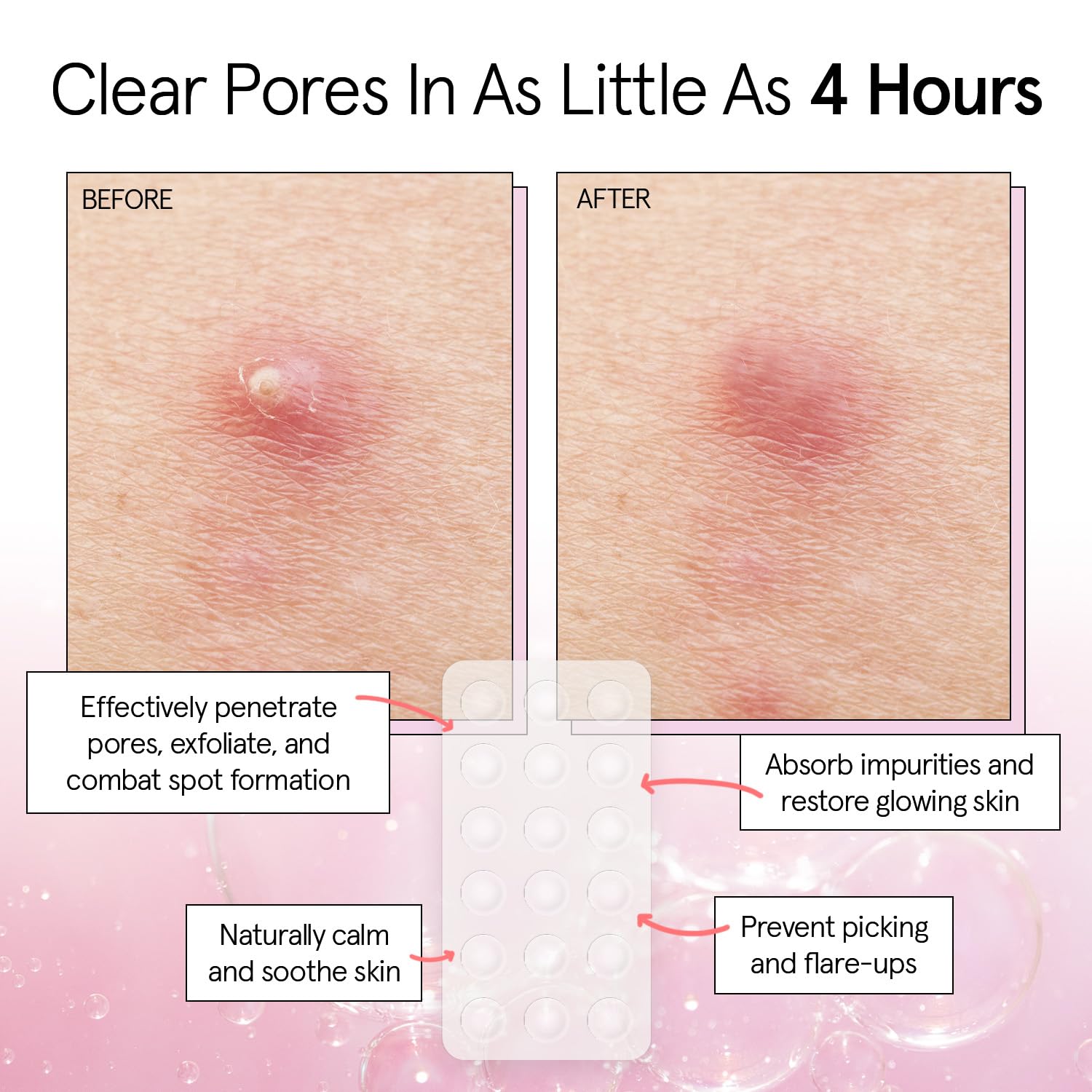 grace & stella Pimple Patches For Face (Round, 36 Count) - Hydrocolloid Acne Patches for Face - Dermatologist Tested, Vegan, Cruelty-Free