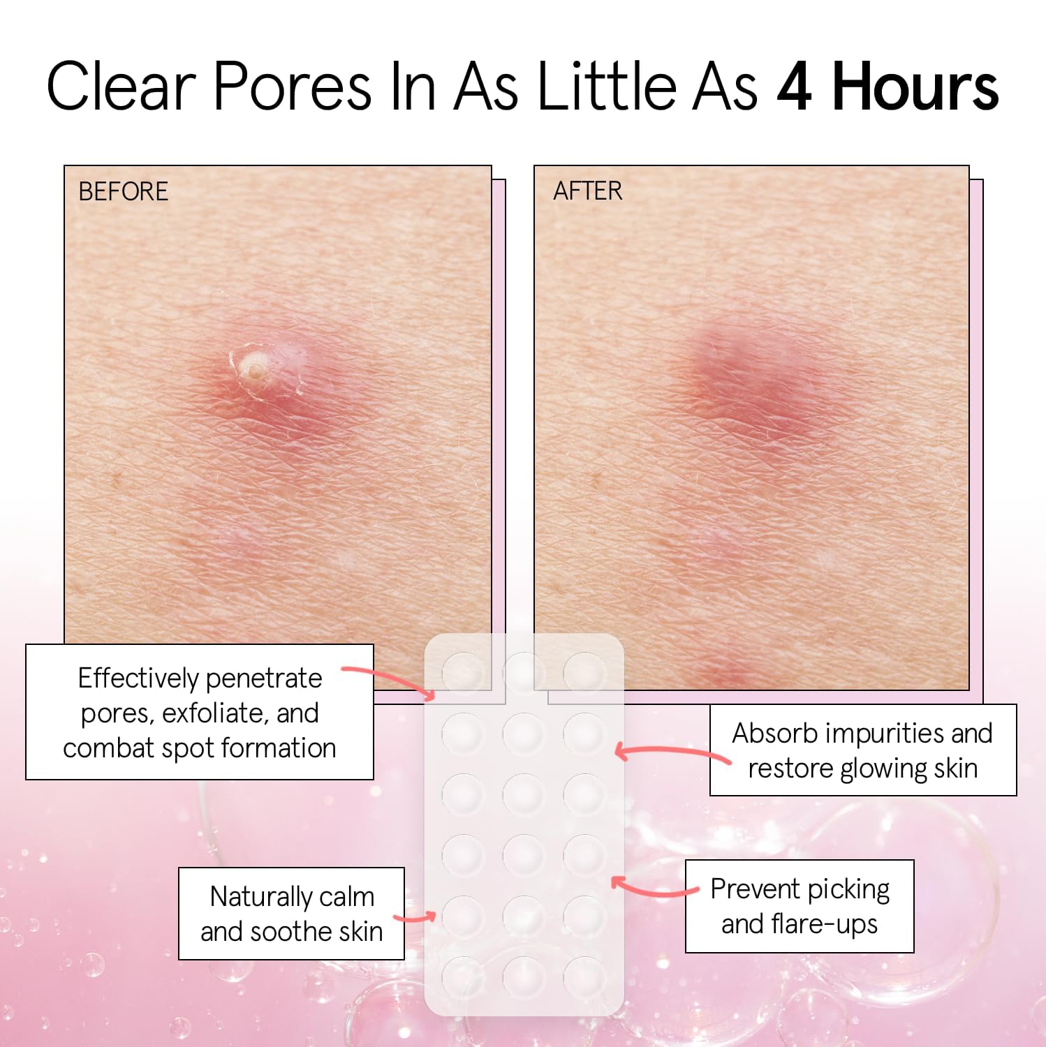 grace & stella Pimple Patches For Face (Round, 36 Count) - Hydrocolloid Acne Patches for Face - Dermatologist Tested, Vegan, Cruelty-Free