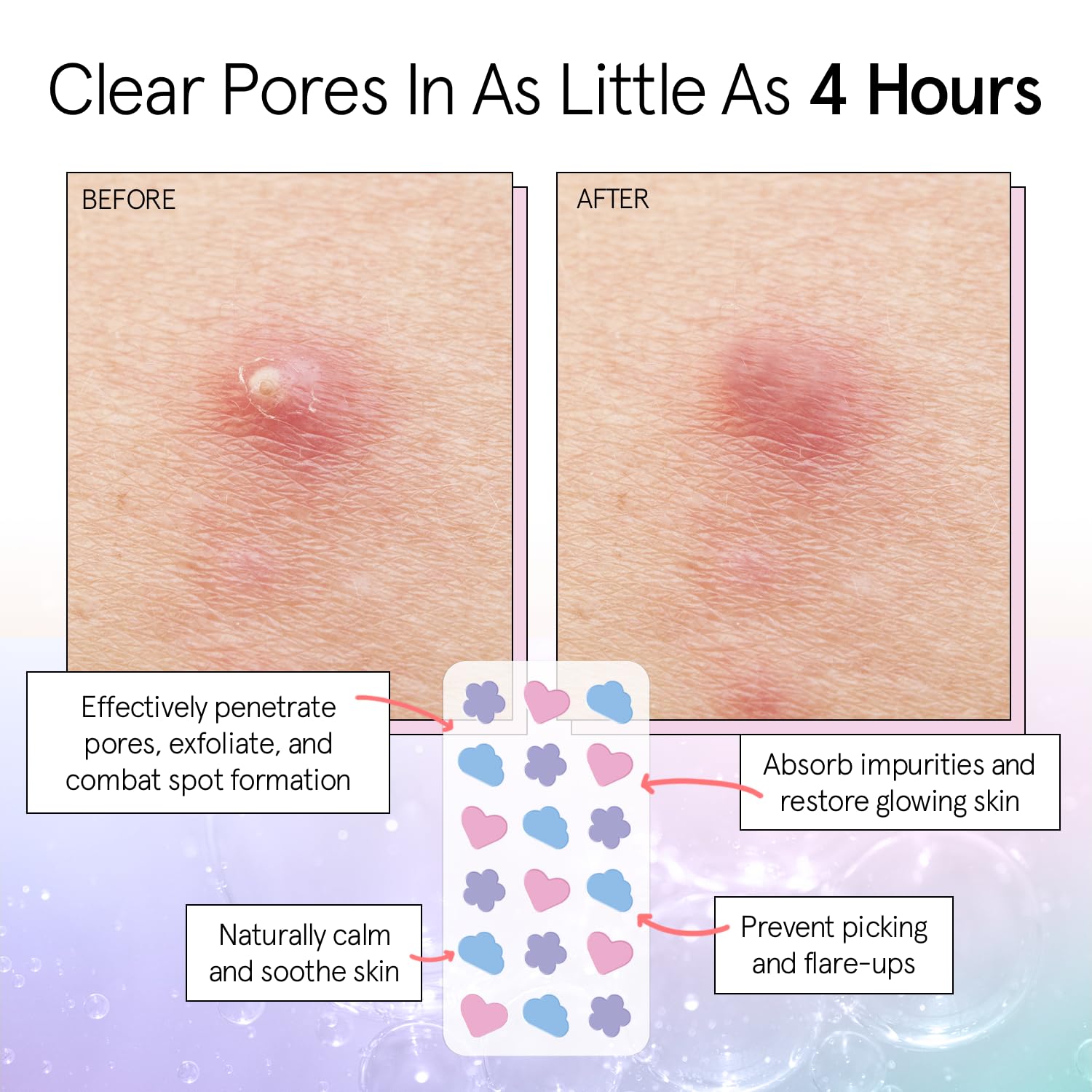 grace & stella Pimple Patches For Face (Round, 36 Count) - Hydrocolloid Acne Patches for Face - Dermatologist Tested, Vegan, Cruelty-Free