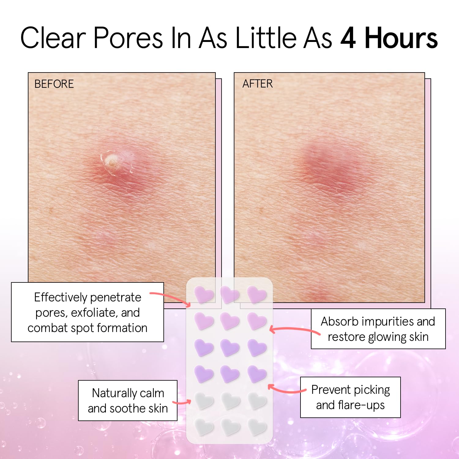 grace &amp; stella Pimple Patches For Face (Heart, 36 Count) - Hydrocolloid Acne Patches for Face - Dermatologist Tested, Vegan, Cruelty-Free