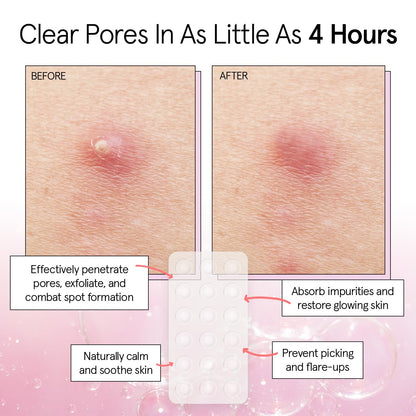 grace &amp; stella Pimple Patches For Face (Round, 36 Count) - Hydrocolloid Acne Patches for Face - Dermatologist Tested, Vegan, Cruelty-Free