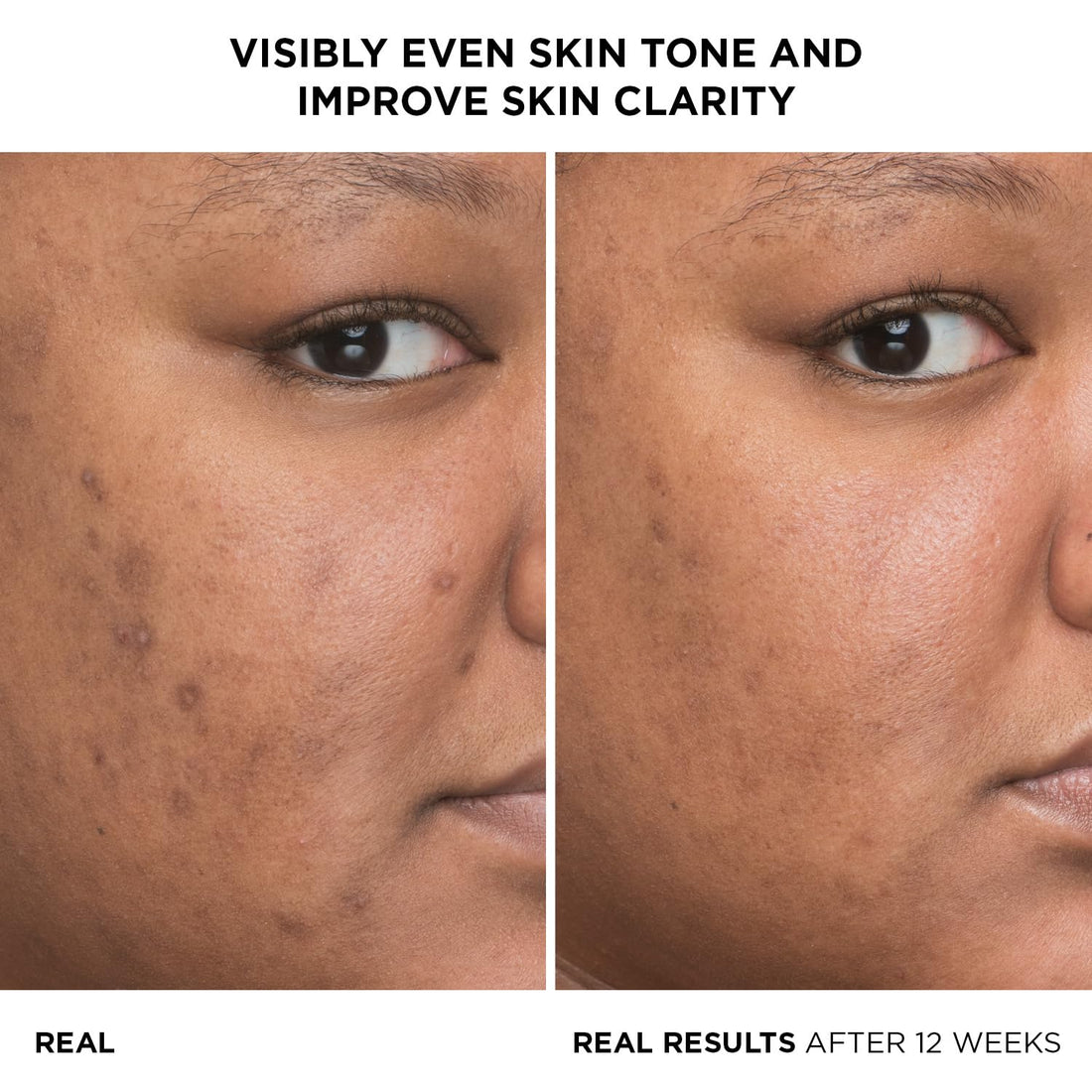 IT Cosmetics Bye Bye Dark Spots 4% Niacinamide Serum - Visibly Reduces Dark Spots &amp; Improves Skin Clarity In 8 Weeks - Facial Serum with 1% Ethyl Vitamin C - For All Skin Types - 1 Fl. Oz