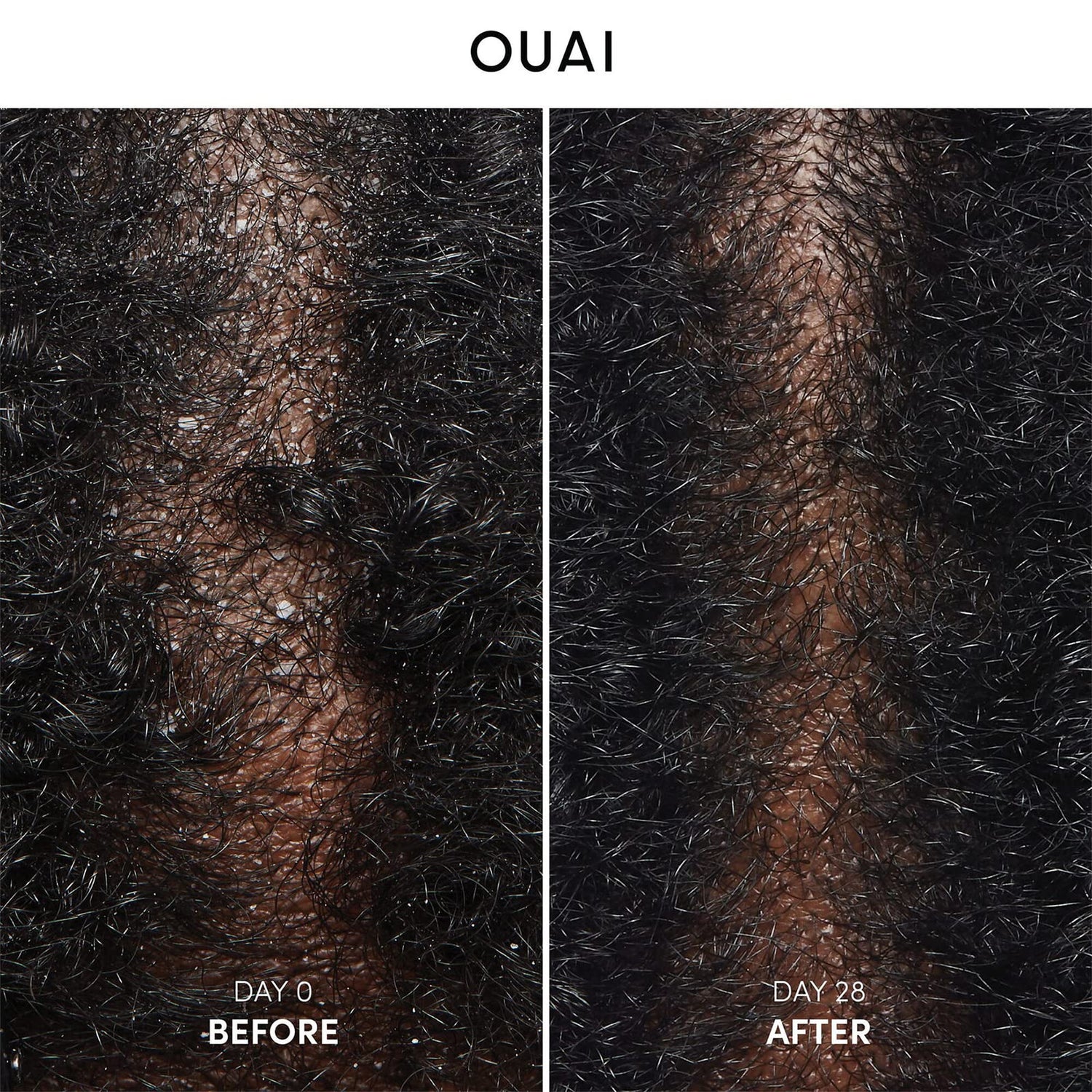 OUAI Anti Dandruff Shampoo - Soothing Salicylic Acid Shampoo for Flaky, Dry and Itchy Scalp - Reduces Itching, Redness and Irritation - Sulfate Free Scalp Care (10 Fl Oz)