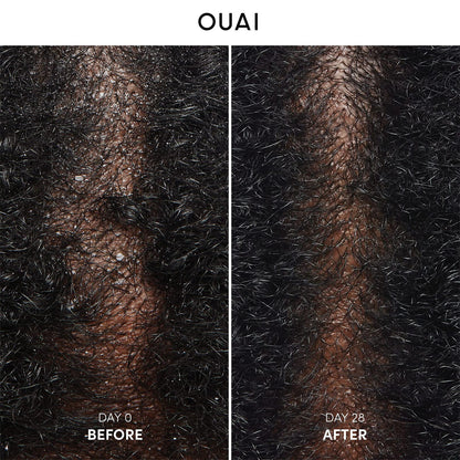 OUAI Anti Dandruff Shampoo - Soothing Salicylic Acid Shampoo for Flaky, Dry and Itchy Scalp - Reduces Itching, Redness and Irritation - Sulfate Free Scalp Care (10 Fl Oz)